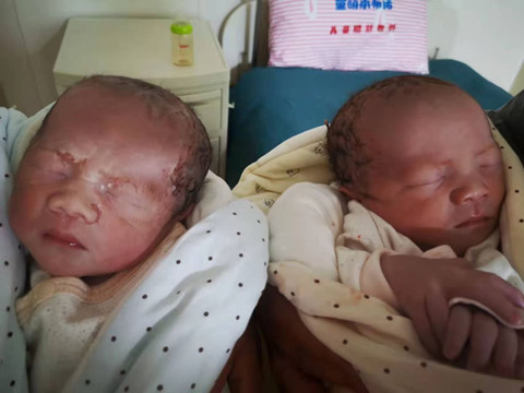 多囊35岁深圳做三代试管婴儿成功怀上双胞胎男孩