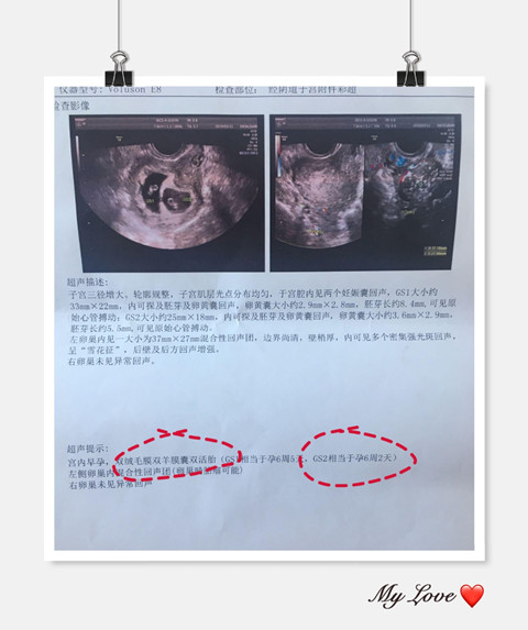 老公染色体平衡异位两次胎停深圳三代试管婴儿一次成功怀上男孩(图2)