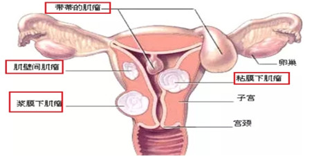 有子宫肌瘤做试管婴儿影响成功率吗(图1)