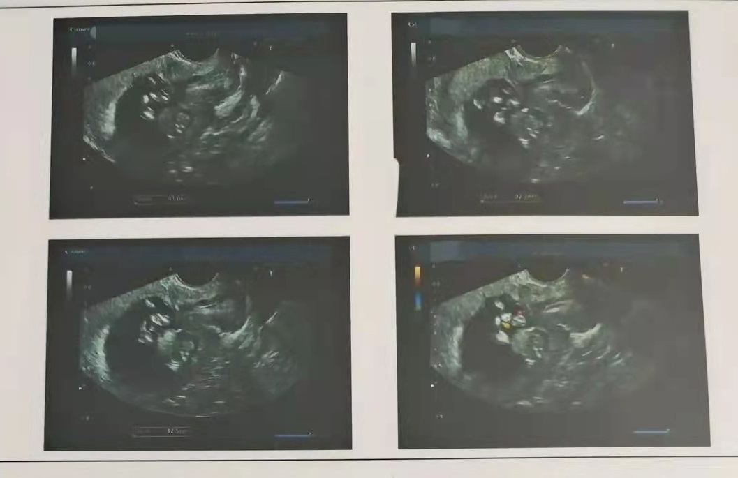 42岁高龄的3次试管经验试管妈妈真心不容易