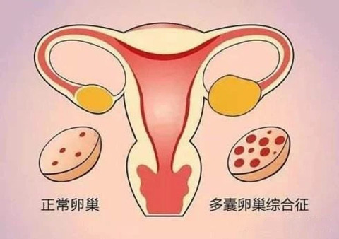 PCOS能做泰国第三代试管婴儿吗