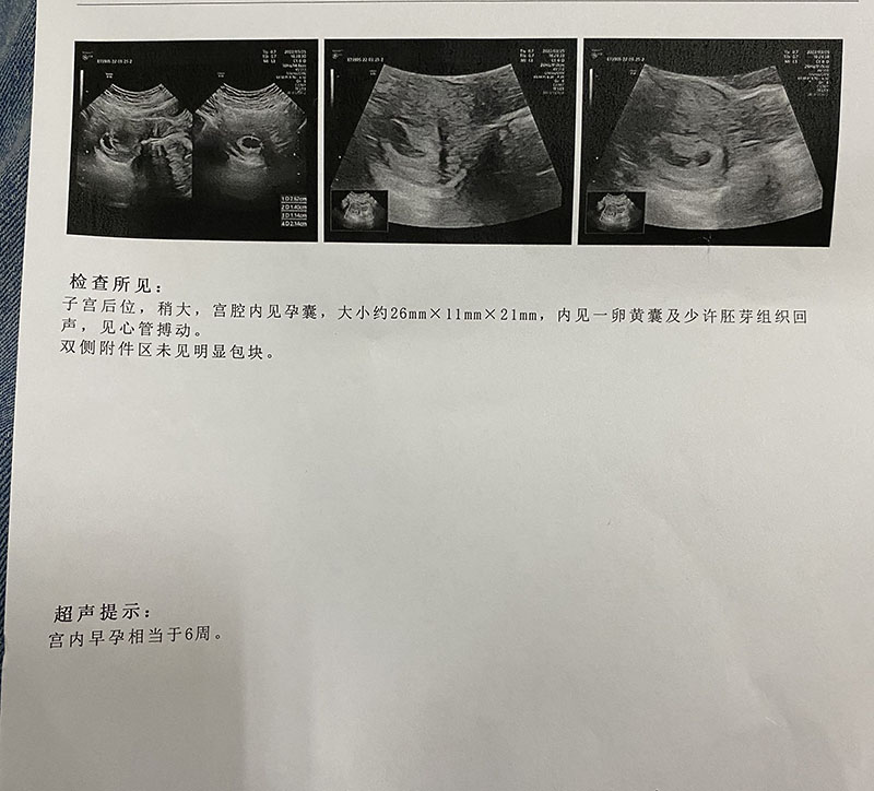 27岁卵巢早衰做试管婴儿竟然一次就怀上了