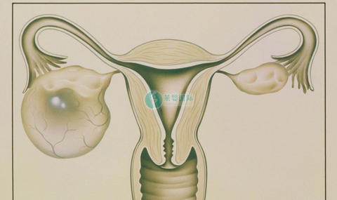 有卵巢囊肿能否做泰国试管婴儿促排？（图1）