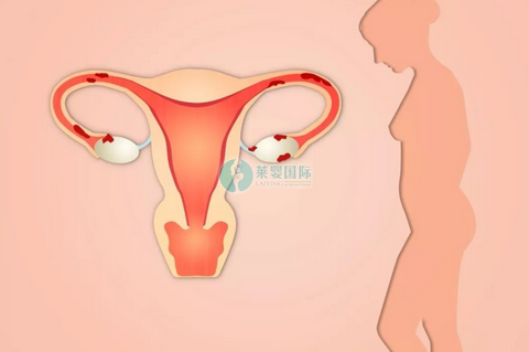 女性输卵管做完通水当月可以做泰国试管婴儿怀孕吗？（图1）