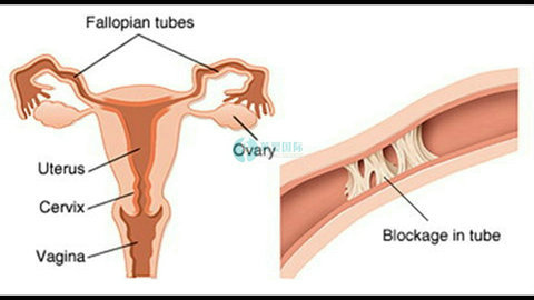 输卵管通而不畅怀孕几率高吗？（图2）