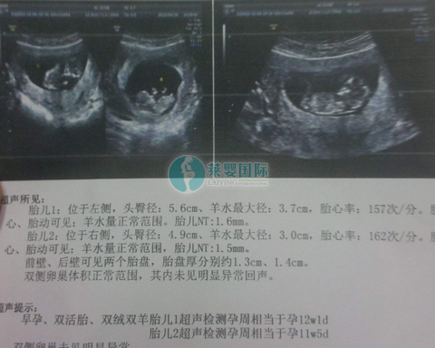 37岁晚婚晚育，泰国试管婴儿挽救了我的婚姻（图2）