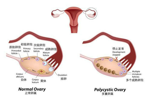 备孕一年没怀上，检查发现多囊卵巢综合征，自然受孕不成，无奈做试管