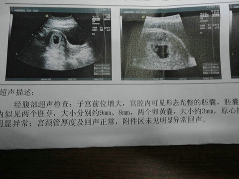 备孕一年没怀上，检查发现多囊卵巢综合征，自然受孕不成，无奈做试管（图2）