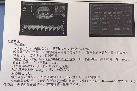 31岁因为想生儿子，去泰国做第三代试管婴儿，一次就中奖（图2）