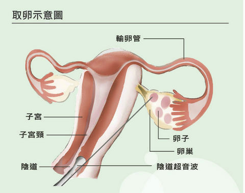 终于等到了泰国试管婴儿移植的这一天，希望一切顺利（图2）