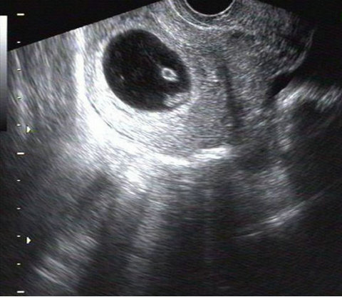 染色体有问题导致不孕，分享我在泰国做试管婴儿的促排卵经历。(图2)
