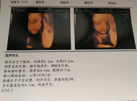 说说我坎坷的怀孕历程，感谢泰国杰特宁试管婴儿医院让我怀上儿子（图3）