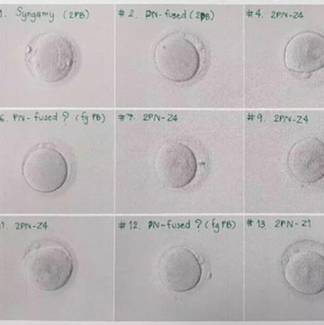 输卵管堵塞做泰国试管婴儿成功率高吗?没想到95年的我也需要做试管才能怀孕