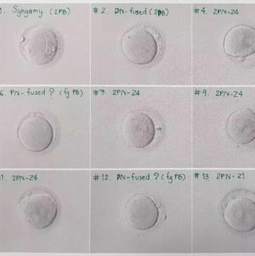 分享我的泰国试管好孕经历，仅有一枚男胚移植成功(图2)