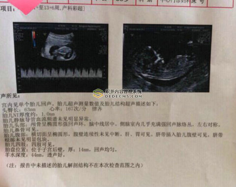 巧克力囊肿致不孕，泰国三代试管婴儿亲身经历分享(图1)