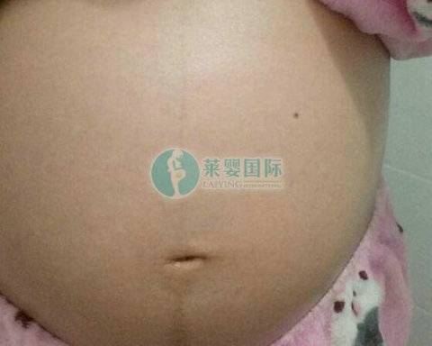 输卵管堵塞不孕做泰国试管婴儿好孕