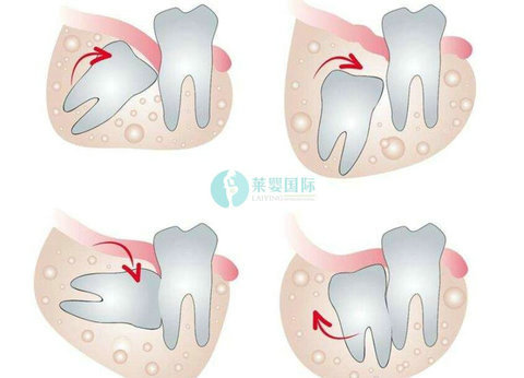 做泰国试管婴儿之前需要拔智齿吗?