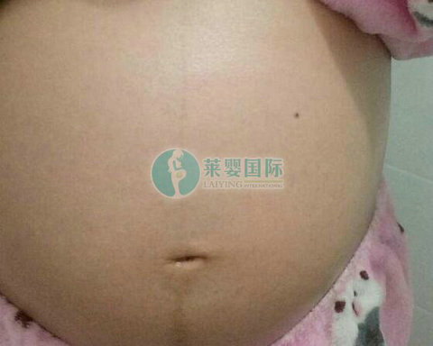 好不容易做试管婴儿怀上了双胞胎为什么还要减胎?