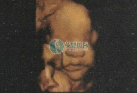 好不容易做试管婴儿怀上了双胞胎为什么还要减胎?（图2）