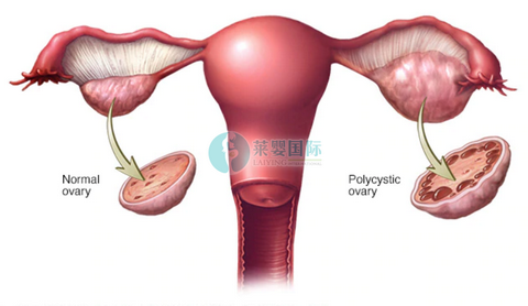 做俄罗斯试管婴儿促排会对女性身体造成伤害吗?