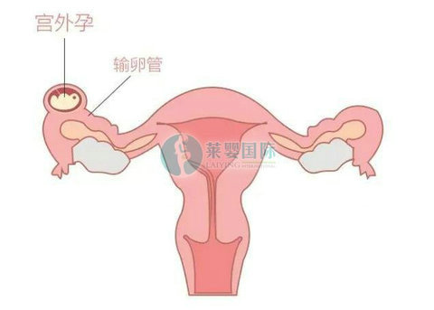 为什么建议多囊卵巢女性早生孩子比较好?