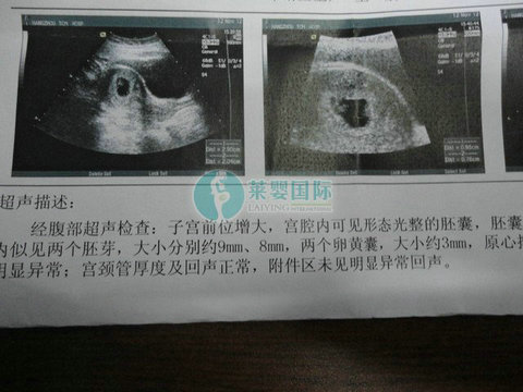 两边输卵管都堵了做试管婴儿成功怀上双胞胎!（图3）