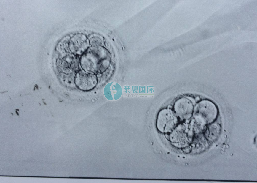 输卵管一侧切除，一侧粘连，试管迎来二胎