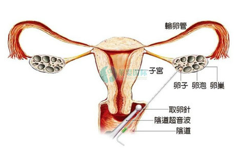 卵巢早衰不可治愈，趁年轻赶紧做试管婴儿吧!