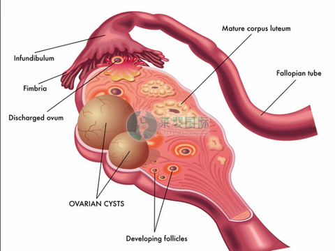 多囊卵巢综合征能做三代试管婴儿吗?