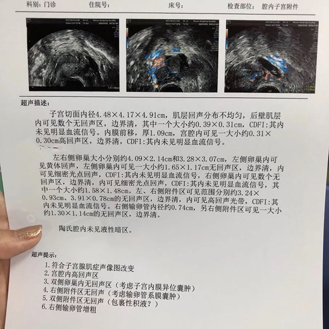 子宫腺症检查报告