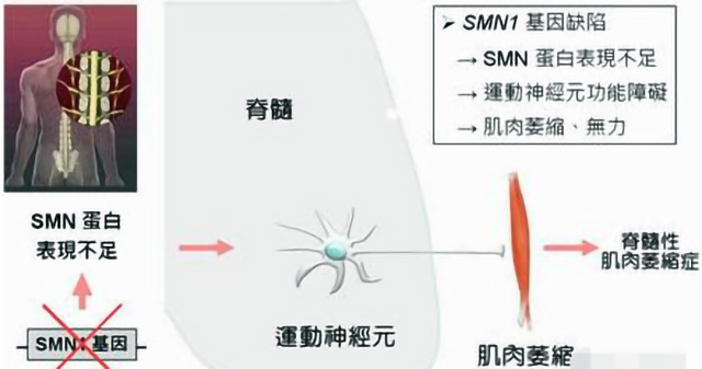 脊髓性肌萎缩症(SMA)做泰国第三代试管婴儿能阻断遗传吗