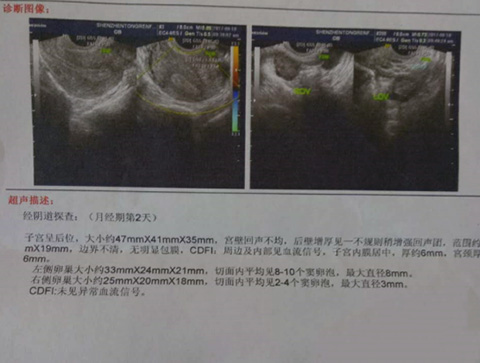 子宫腺肌症做第三代试管婴儿二次移植成功怀上儿子