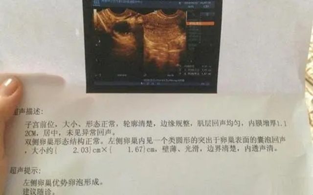 女性卵泡少会影响试管婴儿的最终结果吗？（图1）