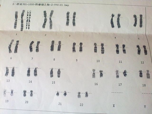 泰国第三代试管婴儿能筛选出哪些遗传疾病？