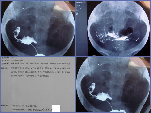 做泰国试管婴儿多囊促排之前需要做输卵管检查吗？（图1）