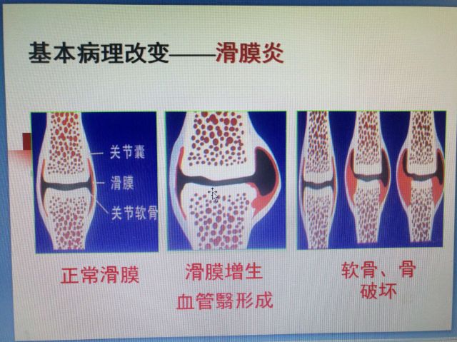 老公风湿免疫性疾病，胎停一次，做泰国试管生下健康宝宝（图1）