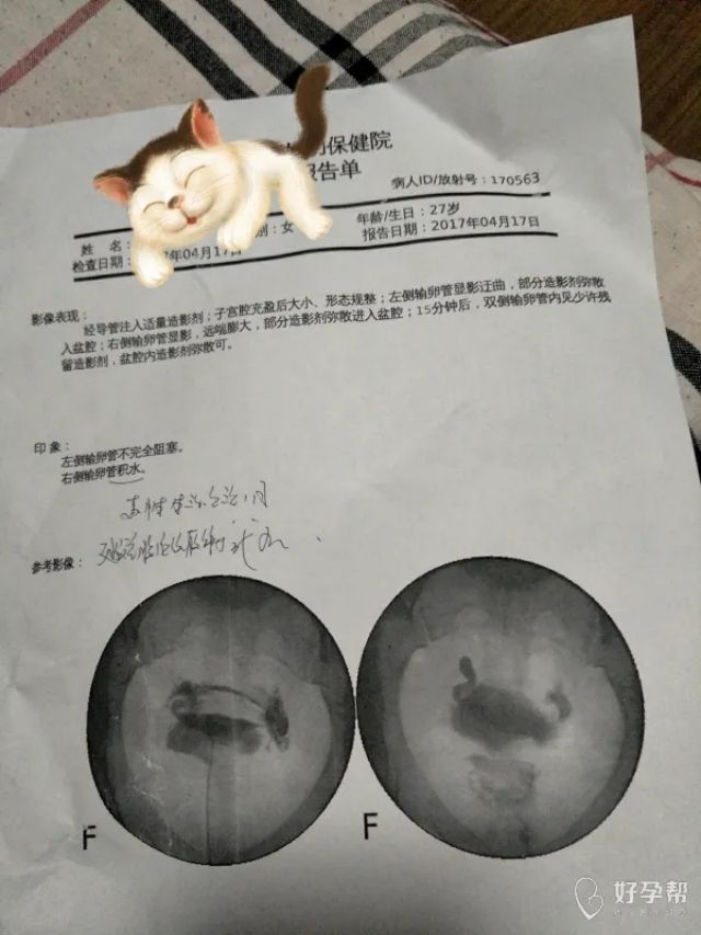 女性备孕时输卵管需要疏通吗？一般要通几次？（图1）