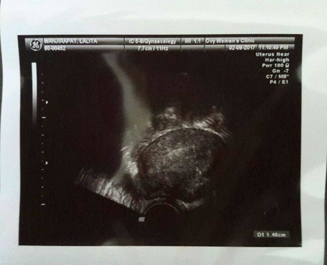 结婚3年不孕，检查又有子宫肌瘤，磕磕碰碰终于怀上了龙凤胎（图1）