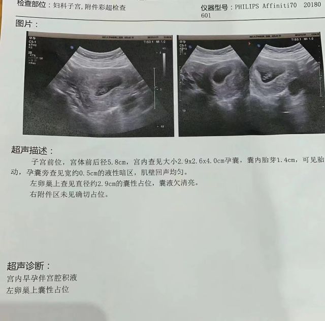 27岁做一次人流后再也怀不上，去泰国做试管婴儿圆我生子梦