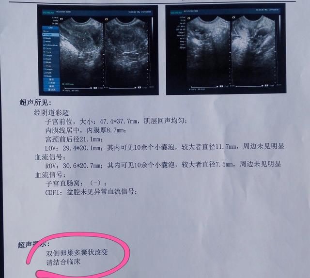 多囊卵巢导致不孕，做泰国试管婴儿生男孩（图1）