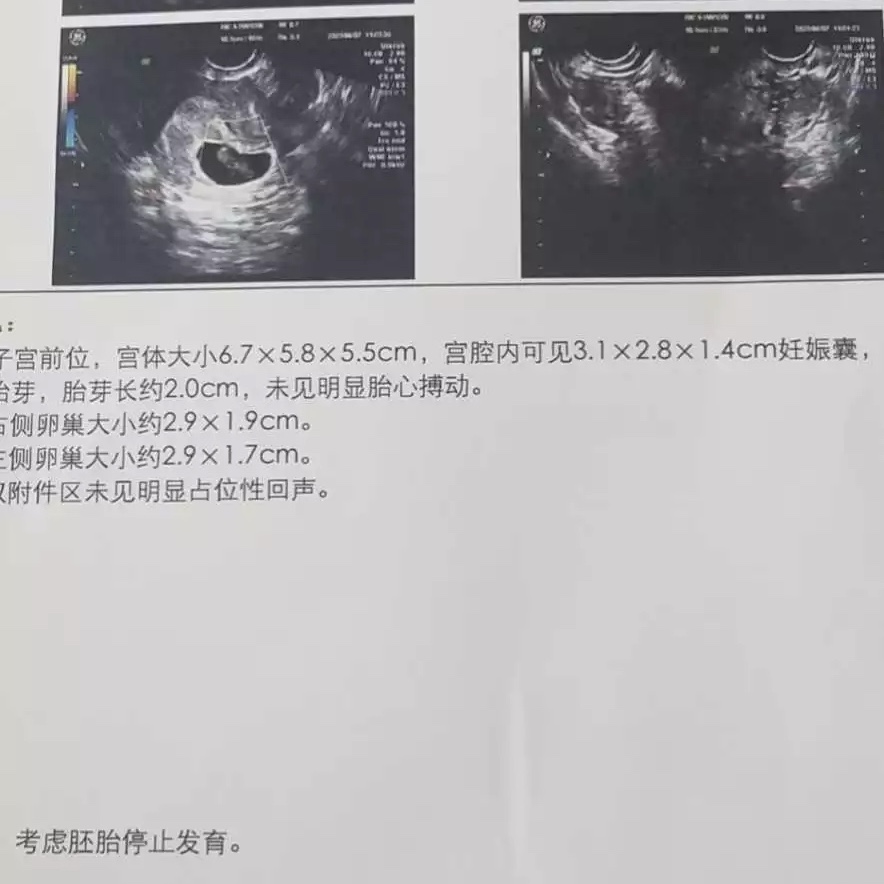 46岁T姐夫妻去泰国做试管婴儿的过程分享