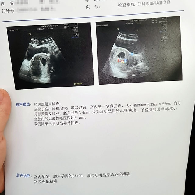 流产导致内膜薄去泰国做第三代试管婴儿成功好孕怀上双胞胎