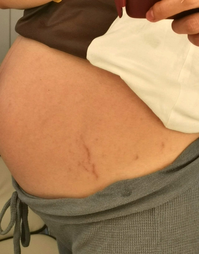 我的试管婴儿成功日记第三代试管成功生儿子