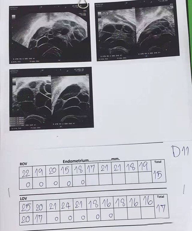 备孕四年未果选择泰国做借卵试管婴儿终于在50岁的时候成功怀上宝宝