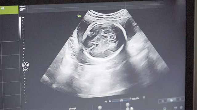 做泰国试管婴儿时，子宫内膜薄对胎停的影响