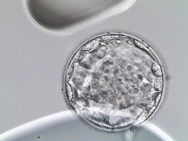 44岁高龄拼二胎，遇卵巢早衰，三代试管婴儿一次成功