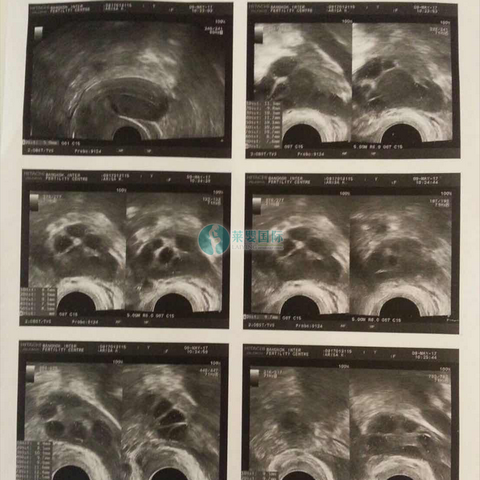 AMH0.31取卵6个泰国试管婴儿成功好孕(图3)